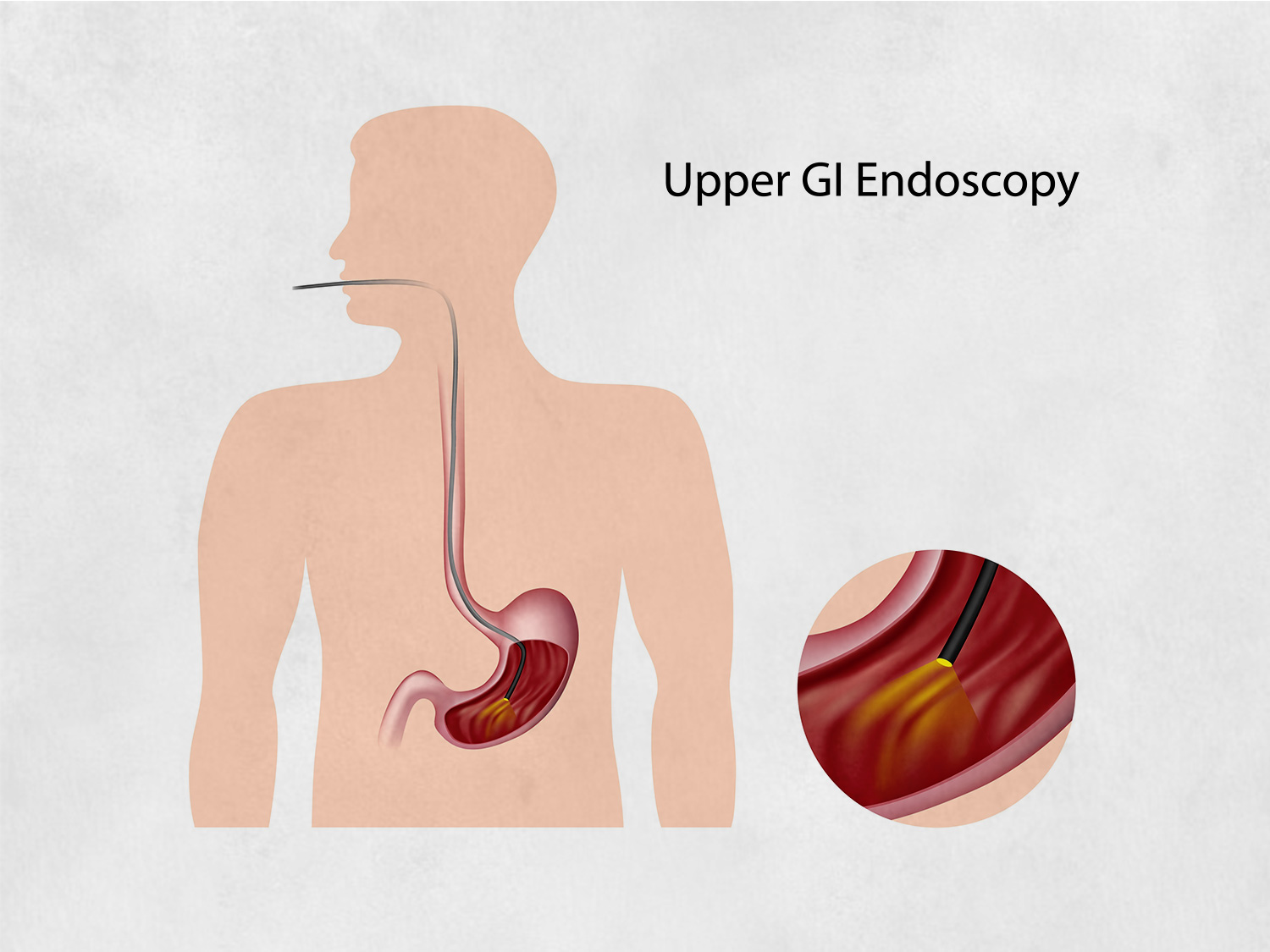 gastroscopy